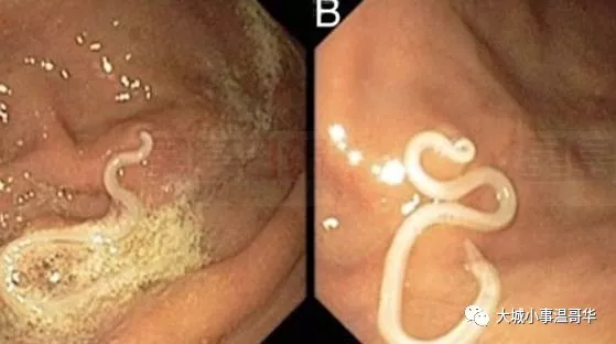 小伙腹泻两周，竟因感染罕见寄生虫鬼脸虫，医生提醒注意个人卫生与饮食习惯,全面分析说明_Linux51.25.11