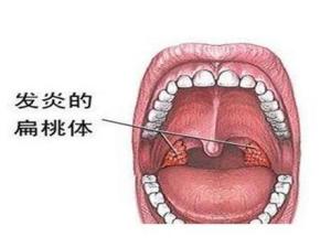 扁桃体发炎化脓怎么治最快最有效