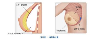 乳房悬吊术是什么意思,乳房悬吊术，一种关于身体塑形与美容的深入探讨,数据设计驱动策略_VR版32.60.93