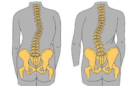 如何自测孩子是否脊柱侧弯